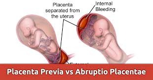How to differentiate placental abruption and placenta previa.