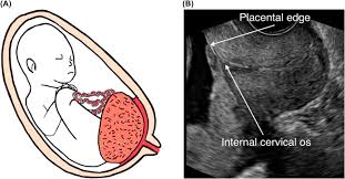 Ultrasound image of placenta previa