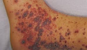 petechial and purpural rash in Von Willebrand disease (VWD) patients.